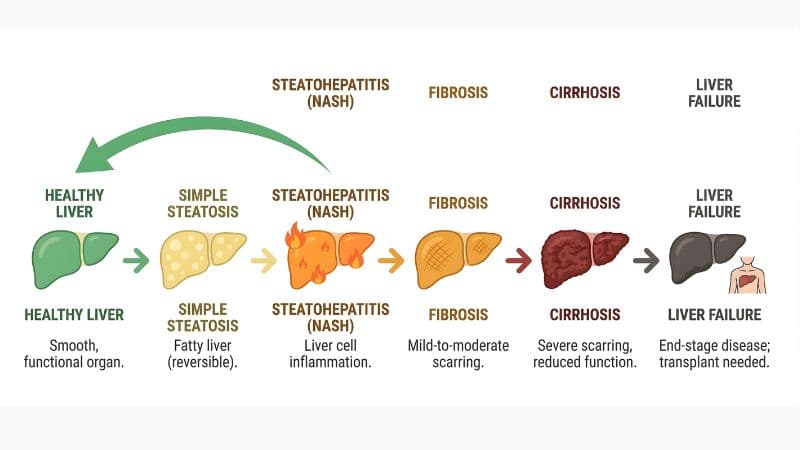 NAFLD vs NASH: What's the Difference and Why Should You Care?