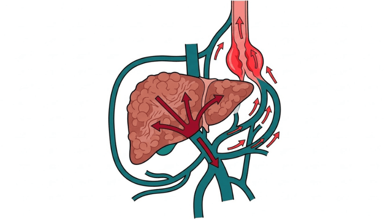 Portal Hypertension and Varices: What Every Liver Patient Should Know