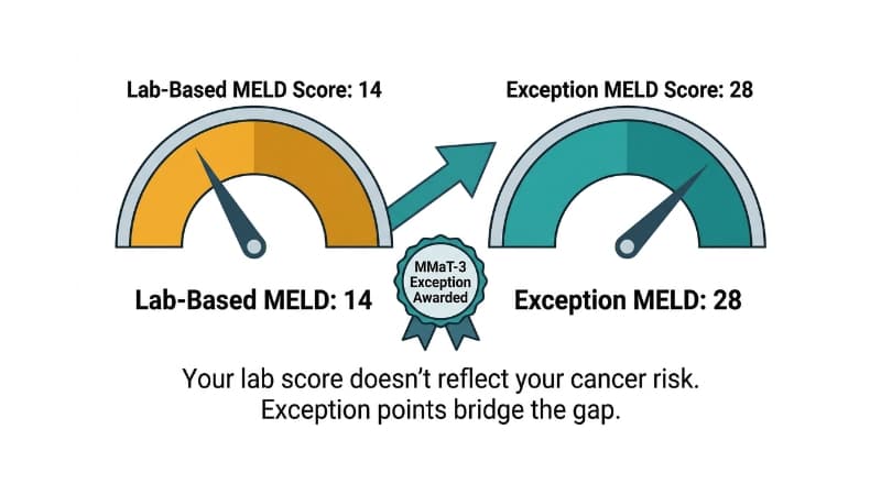 MELD Exception Points: When Your Score Doesn't Tell the Whole Story